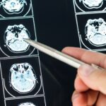 The Unseen Effects of Traumatic Brain Injury