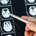 The Unseen Effects of Traumatic Brain Injury The Unseen Effects of Traumatic Brain Injury