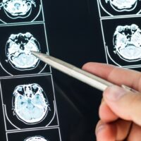 The Unseen Effects of Traumatic Brain Injury The Unseen Effects of Traumatic Brain Injury